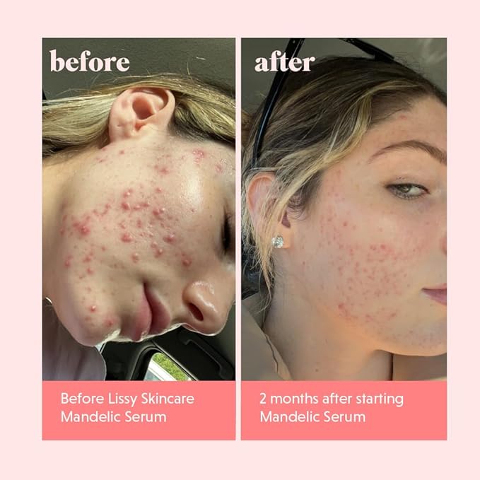 Mandelic Acid Serum Toner Exfoliant | Great For Acne Breakouts, Reduce Redness, Balancing Treatment | Plus Niacinamide, Licorice Root & Hyaluronic Acid, Hydration (Lissy Skincare)