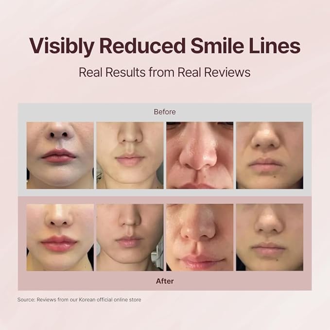 Averin Smile Line Care Kit - Korean Facial Tool with UV Storage Case | Custom-Fit Moldable Mouthpiece | Daily 10-Minute K-Beauty Routine for Facial Contour & Smoothing