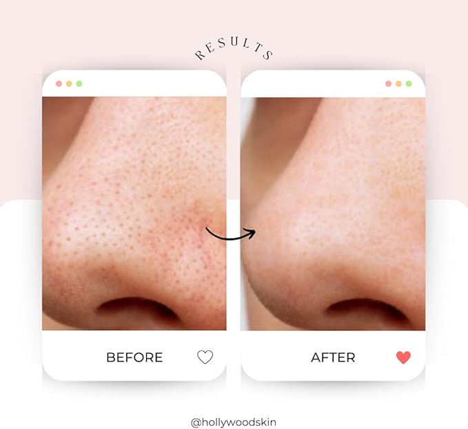 Clarifying Toner - Sweden’s #1 skin care brand* Glow BHA + PHA Pore-Tight Facial Toner - Mild Exfoliating Toner with Hyaluronic Acid, Green Tea, Citric Acid + Tea Tree. 120ml