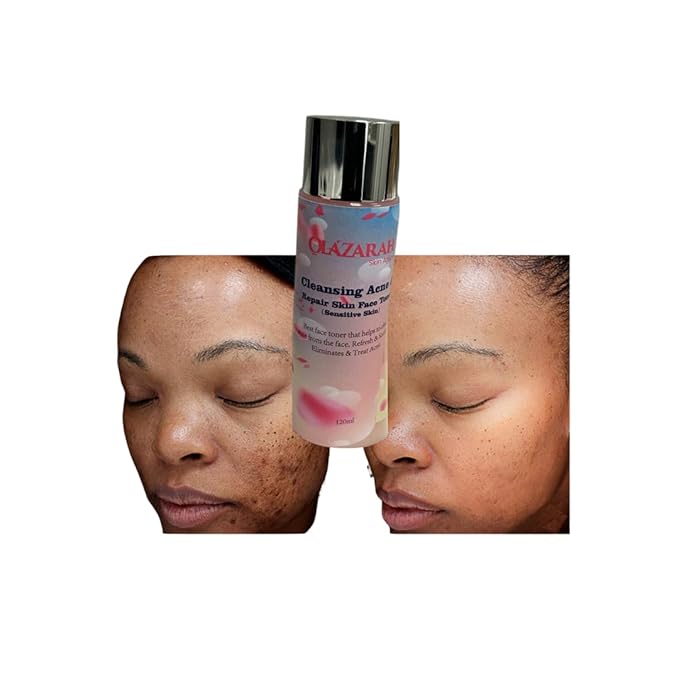 Skin-Clarifying Face Toner for Acne Treatment - Gentle on Sensitive Skin, Refreshes, Soothes, and Eliminates Acne, 4 Fl. oz