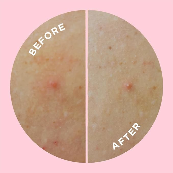 ZitSticka Pimple Patches for Face and Body, Goo Getter Hydrocolloid Patches to Cover Zits & Blemishes, Acne Patches or Zit Spot Stickers, Blemish Patch (Body Patch 9 Pack)