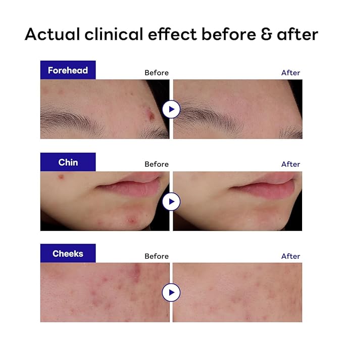 Mediheal Derma Clear Madecassoside Blemish Spot Patch (44 Counts) - Acne Spot Protection, Spot Fast Healing with Madecassoside & Niacinamide