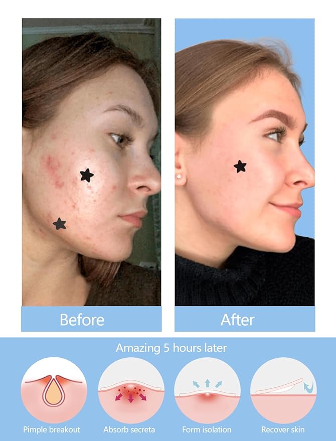 306 Counts Black Star Pimple Patches for Face, Hydrocolloid Star Acne Patches Refill, Cute Zit Covers for Face, Spot Stickers with Tea Tree, Salicylic Acid and Cica Oil