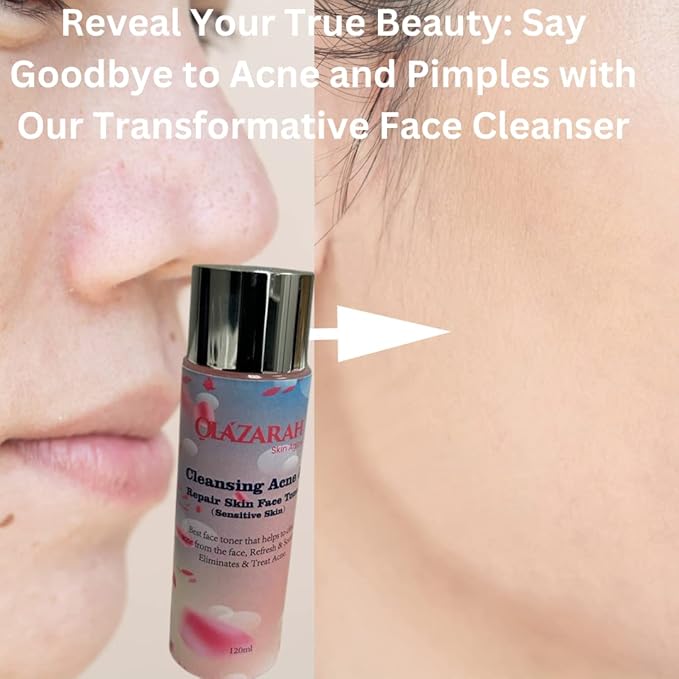 Skin-Clarifying Face Toner for Acne Treatment - Gentle on Sensitive Skin, Refreshes, Soothes, and Eliminates Acne, 4 Fl. oz