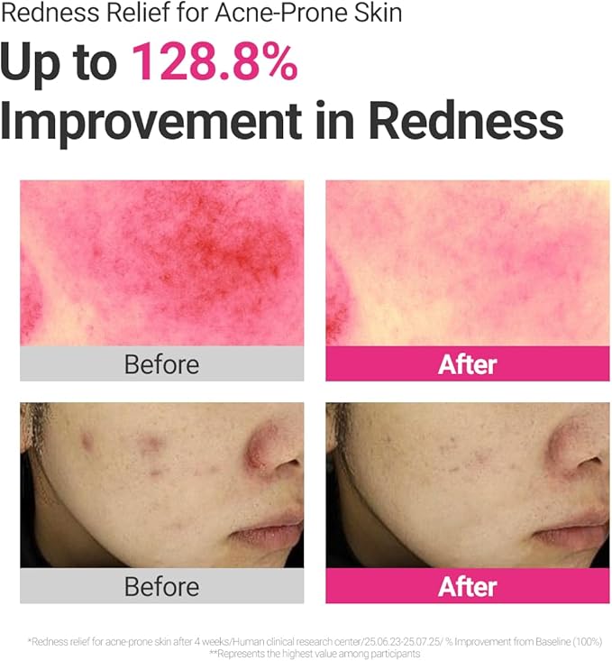 ROVECTIN Dr. Mask CICA Blemish Toner Pad | Redness & Acne Soothing Pads with Pink CICA Complex + Centella Exosomes | Succinic Acid Calming | pH-Balanced Hydrating Pads for Sensitive Skin