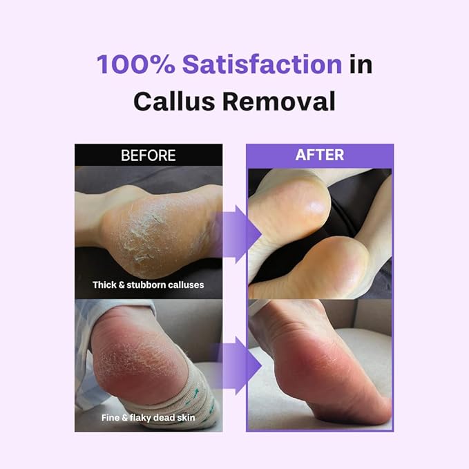Baren Foot Callus Remover Kit |1-Min Spray & Peel |13 Naturally derived ingredients |Professional Level Gentle Removal of Dead Skin |Premium Grade Stainless Steel |3.3oz Callus Peeling Spray+Foot File