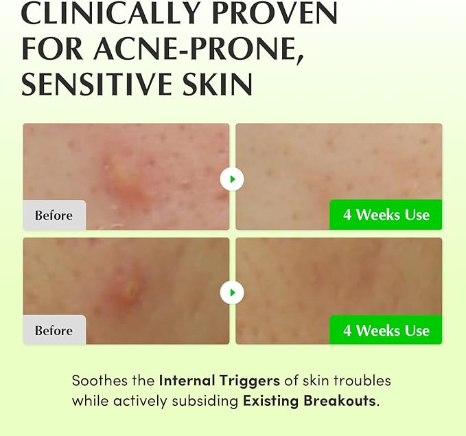 EQQUALBERRY Aloe PDRN Calming Toner, for Sensitive, | Instant Relief & Cooling | Non-Comedogenic & Fungal Acne Safe, Skin Barrier Repair | K-Beauty (5.07 fl.oz / 150ml)