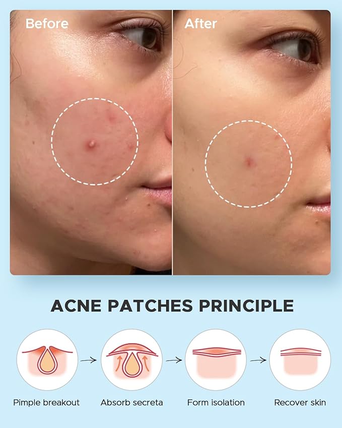 LitBear Acne Pimple Patches- Day and Night 4 Sizes 180 Dots Thin & Thick Hydrocolloid Patches with Witch Hazel, Tea Tree & Calendula Oil, Pimple Stickers for Covering Zits, Blemishes, Spots, Acne Dots
