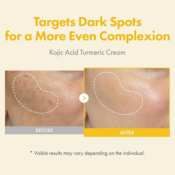 TOSOWOONG Kojic Acid Turmeric Cream, 99% Purity Kojic Acid 7,000ppm, 660,941ppm Turmeric, Dark Spot Corrector Capsule for Hyperpigmentation & Even Skin Tone Care, Korean Skincare, 50ml / 1.69 fl. oz.