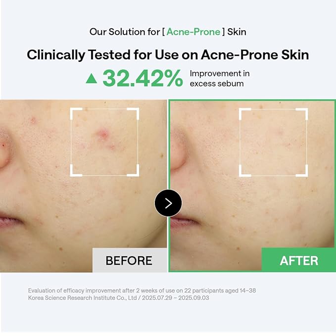 Mediheal Teatree Pad & Serum Duo Set for Quick Skin Calming & Redness Relief - Teatree Trouble Calming Toner Pads (100 Count) + Teatree Serum (1.35 fl.oz)
