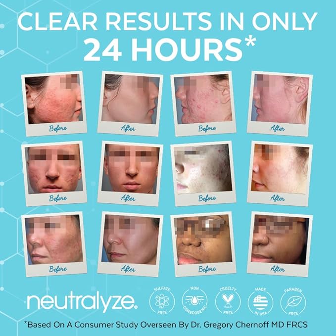 Neutralyze Exfoliating Acne Treatment Wipes - Maximum Strength, Textured Acne Pads with Mandelic Acid & Salicylic Acid for Face & Body - Suitable for All Skin Types, Teens & Adults (100 Wipes)