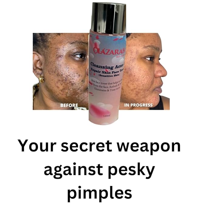 Skin-Clarifying Face Toner for Acne Treatment - Gentle on Sensitive Skin, Refreshes, Soothes, and Eliminates Acne, 4 Fl. oz