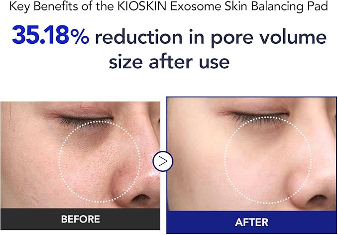 35% Smaller Pores & 32% Reduced Pore Area | Brightening Exfoliating Pads | Soothes, Hydrates & Brightens with CICA Exosomes, AHA/BHA/PHA & Fruit Enzymes | Korean Skincare | 70 Pads