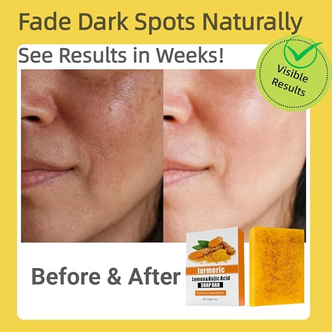 3 Pack Lemon & Turmeric Soap Bar for Dark Spots, Powered by Kojic Acid, Vitamin C - Deeply Moisturizing with Amino Acids & Shea Butter - SLS Free for Face/Body