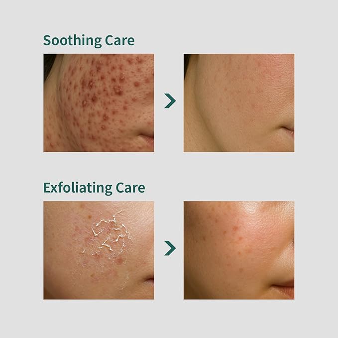 coxir Tea Tree Pore & Sebum Toner | Oil Balance, Pore Minimizer, Sebum Control | Paraben Free, Cruelty Free, Korean Skin Care[150ml/5.07 fl.oz]