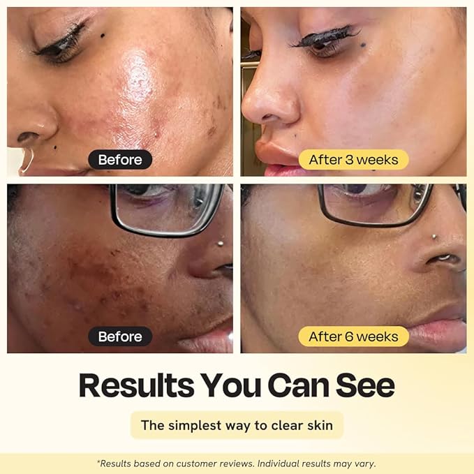 Gleamin Vitamin C Clay Mask for Dark Spots - Brightening Clay Face Mask with Turmeric, Deep Cleansing & Pore Refining Treatment, Helps Improve Uneven Tone & Post-Blemish Texture, 5 oz Up to 40 Uses