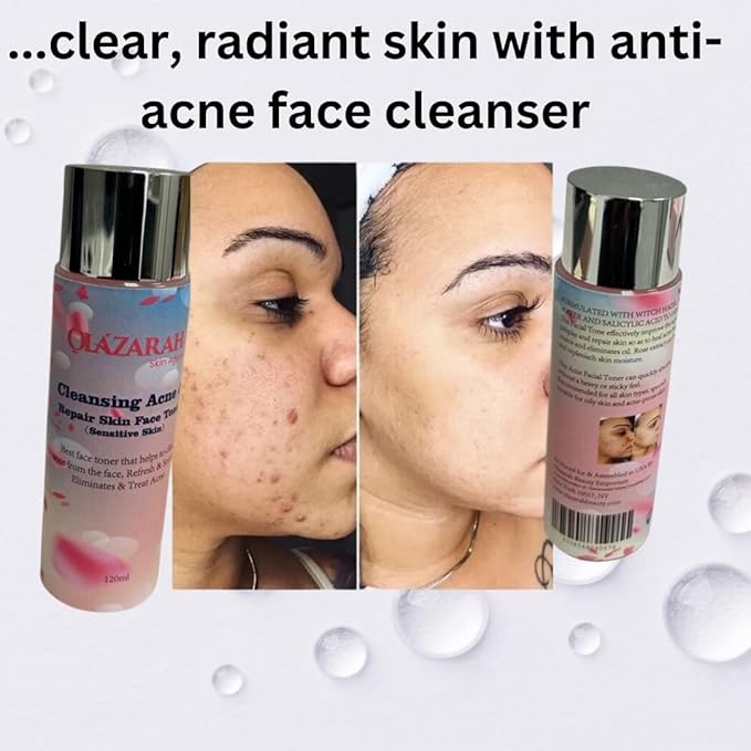 Skin-Clarifying Face Toner for Acne Treatment - Gentle on Sensitive Skin, Refreshes, Soothes, and Eliminates Acne, 4 Fl. oz