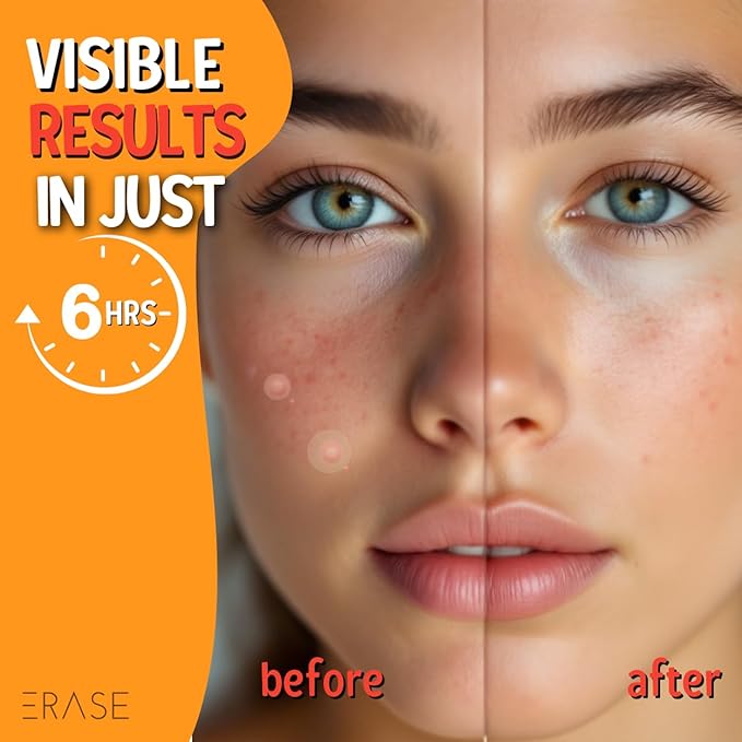 ERASE Clear Skin 3-Step System | Spotless Serum + Pro-Collagen Hydrating Mask + Acne Patches | Brighten, Hydrate & Clear Skin | Niacinamide, Vitamin C & Collagen | For Teens & Adults