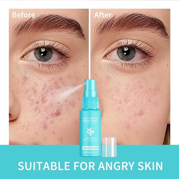 Daily Rescue Facial Spray, Hypochlorous Acid Spray, Reduce Redness and Breakouts, 100% Natural Fragrance Free, Alcohol Free, Oil Free, Cruelty Free Vegan (1)