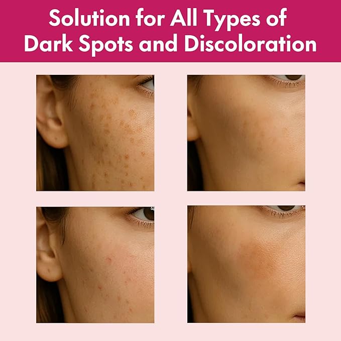 Arbutin 7% + Tranexamic Acid 4% Face Cream for Dark Spots & Uneven Skin Tone – Hydrating, Non-Irritating, Safe for Sensitive Skin 1.76 oz (Pack of 1)