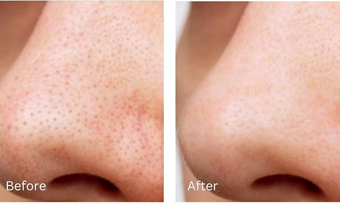Clarifying Toner - Sweden’s #1 Skin Care Brand* Glow BHA + PHA Pore-Tight Facial Toner - Mild Exfoliating Toner with Hyaluronic Acid, Green Tea, Citric Acid + Tea Tree. 120ml