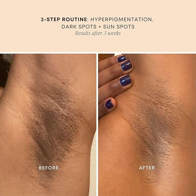Bushbalm Dark Spot Oil - Helps Brighten and Reduce Hyperpigmentation, Razor Burn & Underarm Bumps - Soothe Skin from Post Shave Itchiness, Irritation & Redness, 30 ml - Bermuda Oil