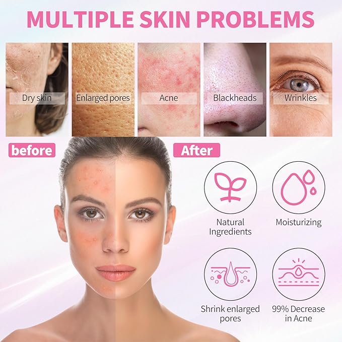 Daily Acne Essentials Kit - 5 Step Facial Skincare Set with Cleanser, Face Scrub, Clay Mask,Toner & Acne Serum, Complete Acne Skin Care Kit, Wash Away Impurities To Reveal Glowing Skin
