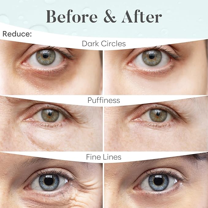 Hyaluronic Acid Under Eye Patches (30 Pairs) - For Dark Circles & Puffiness - Hydrating Eye Mask for Care