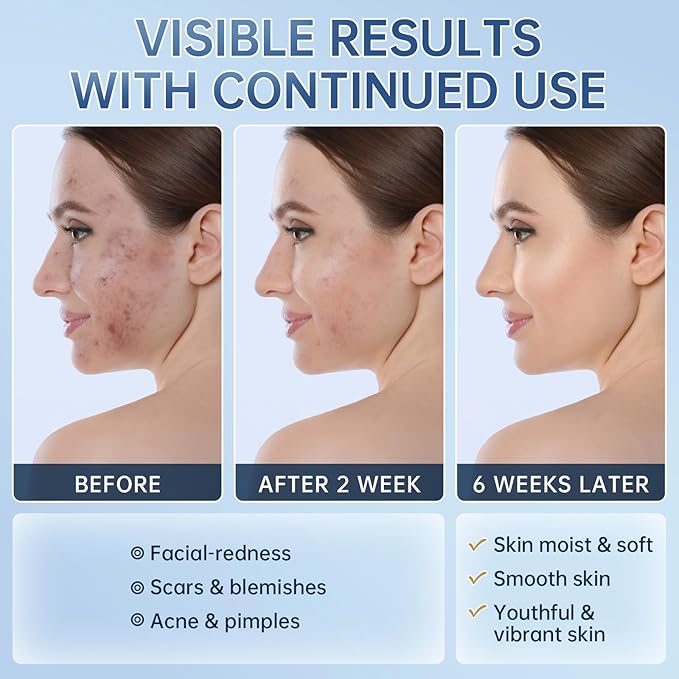 Azelaic Acid 14% Acne Cream for Redness Relief, Dark Spots, Facial Serum with Niacinamide & Vitamin C Prevent Acne Breakouts, Azelaic Acid Serum for Balance Excess Sebum & Soothe Irritation, 2 Oz.