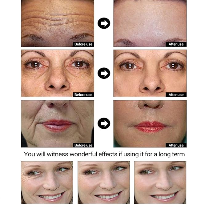 5X Vitamin C 20% Serum for Face with Hyaluronic & Amino Acids - Boost Skin Collagen, Hydrate & Plump Skin, Anti Aging & Wrinkle Facial Serum, All Skin Types, 30 ML / 1.0 Fl Oz (Vitamin C Serum)