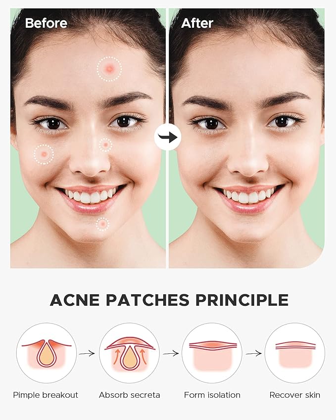 Pimple Patch (360 Counts 4 Sizes), Hydrocolliod Acne Patch for Face, Invisible Zit Patch with Tea Tree Oil & Calendula Oil, Blemish Patch