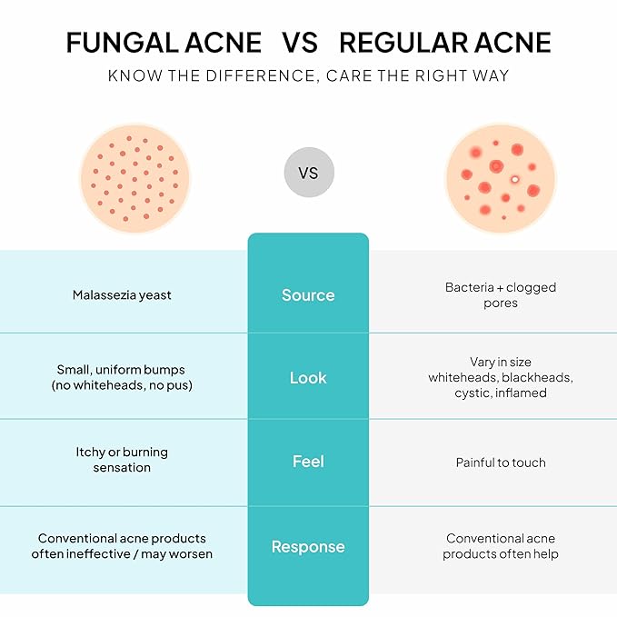 Fungal Acne Treatment Lotion: Helps with Bumps, Clusters, Itch & Redness – Lightweight Anti-Fungal Face & Body Moisturizer for Fungal Skin with Natural Actives & Soothing Plant Extracts