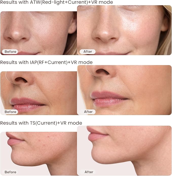 Skin Tightening Device | 6 in 1 Radio Frequency Skin Tightening Device | Professional Face Tightening | Lifting | Wrinkle Reducing | Depuff | Absorb | at Home RF Anti Aging Face Beauty Device