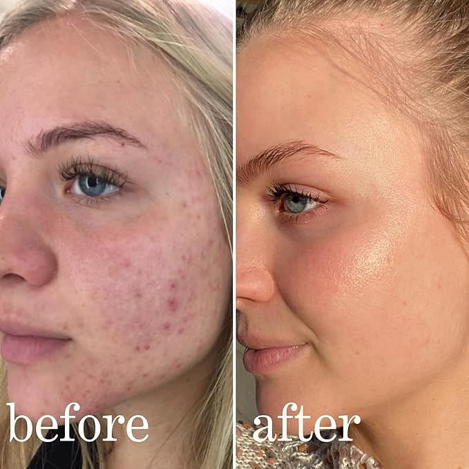 Mandelic Acid Serum Toner Exfoliant | Great For Acne Breakouts, Reduce Redness, Balancing Treatment | Plus Niacinamide, Licorice Root & Hyaluronic Acid, Hydration (Lissy Skincare)