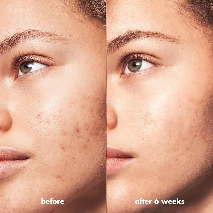 e.l.f. SKIN Blemish Breakthrough Calming Water Cream, Lightweight Blemish-Fighting Face Moisturiser, Prevents New Blemishes & Calms Skin (Pack of 2)