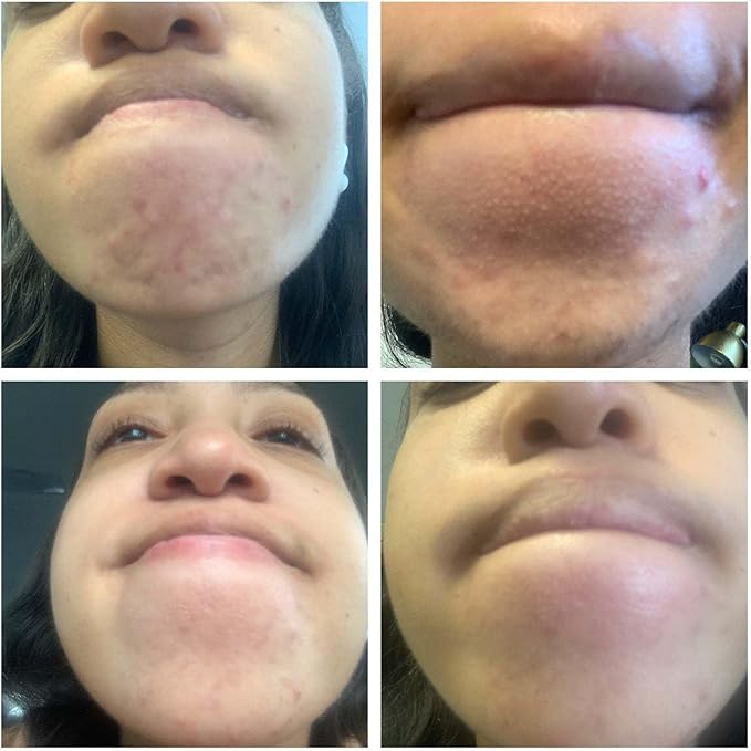 BalanC Toner | Pregnancy Safe Blemish Treatment | Aloe Vera & Witch Hazel | Alcohol Free