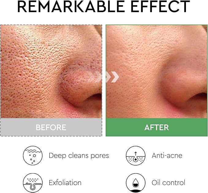 Salicylic Acid Acne Glycolic Acid Toner Pads, Alcohol Free, Ultra-Thin Easy to Absorb Acne Pore for Exfoliation Facial Peel for Blackhead, Acne for Deep Cleaning for All Skin Types(80 Pads)