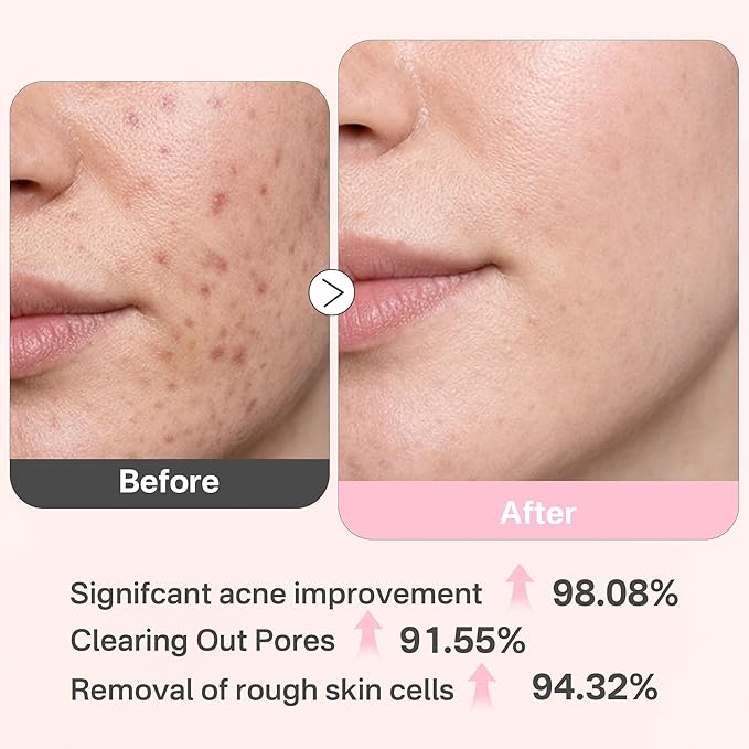 Glycolic Acid 20% Resurfacing Pads (50 Count), Exfoliating Peel Pads for Face, Skin Pore Resurfacing & Radiance, Exfoliating Toner Facial Pads with Oil, Salicylic Acid & Vitamins E, B3, B5