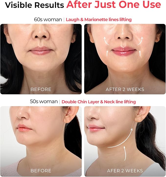 Aalok Ultra Olla | At-Home RF & LED Facial Device for Lifting, Anti-Aging Routine
