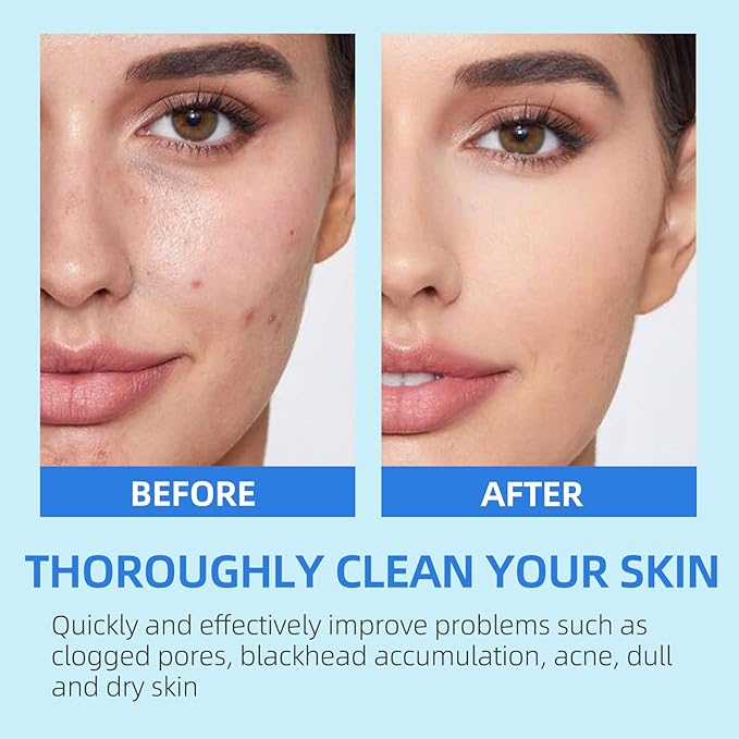 BS-MALL Zero Pore Pads – Dual-Textured Facial Toner Pads with 4.5% AHA Lactic Acid & 0.45% BHA Salicylic Acid for Exfoliation, Pore Care & Acne Treatment – 70 Pad for All Skin Types