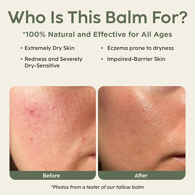 Beef Tallow for Skin - Grass-Fed Tallow Balm with Organic Squalane & Oat Extract | Whipped Face & Body Moisturizer for Extremely Dry Skin, Non-Greasy, Additive-Free, Unscented (1.5oz)
