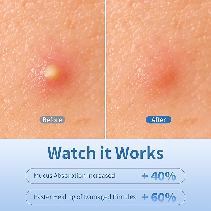 Pimple Patches for Face, 3 Size 280 Counts Hydrocolloid Acne Patches, Cute Star Pimple Stickers with Salicylic Acid, Tea Tree Oil & Calendula Oil, for Covering Zits and Blemishes