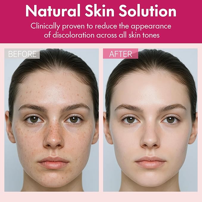 Arbutin 7% + Tranexamic Acid 4% Face Cream for Dark Spots & Uneven Skin Tone – Hydrating, Non-Irritating, Safe for Sensitive Skin 1.76 oz (Pack of 1)