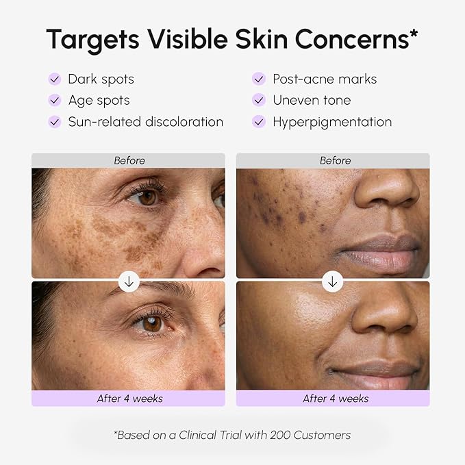 MAREE Dark Spot Remover for Face and Body – Dark Spot Corrector Serum – Hyperpigmentation, Melasma, Sun & Age Spots – Black & Brown Spot Remover for Women – Crema para Manchas Oscuras en la Cara