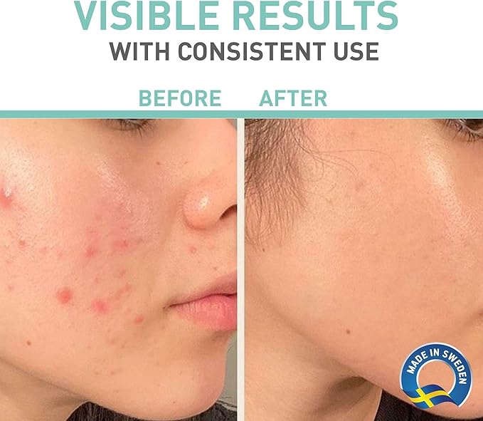 Complete Acne Treatment Routine, 3 Step Daily Routine with Foaming Cleanser, Revitalizing Toner & Sebum Control Cream, Dermatologocally & Clinically Tested, 2 Month Supply