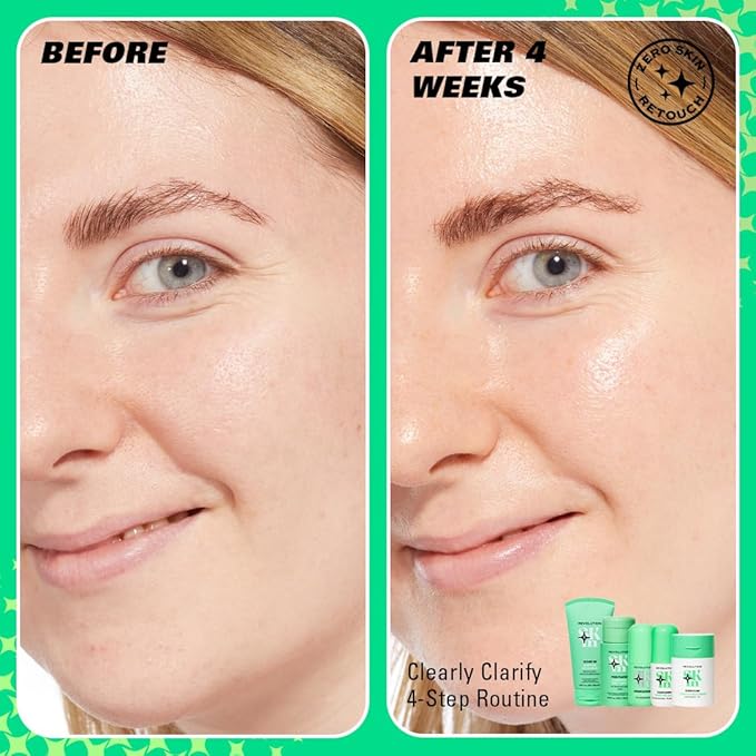Revolution Skin, Clearly Clarify 4 Step Starter Kit, Skincare Set for Blemish-Prone Skin with Cleanser, Toner, Serum & Moisturizer, Vegan & Cruelty-Free, 4 Mini Products