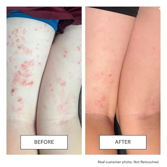 Untoxicated Moisturizing Cream - Facial Moisturizer & Body Cream for Sensitive Skin and NEA Approved for Eczema Relief - Ceramides & Hyaluronic Acid with No Common Irritants