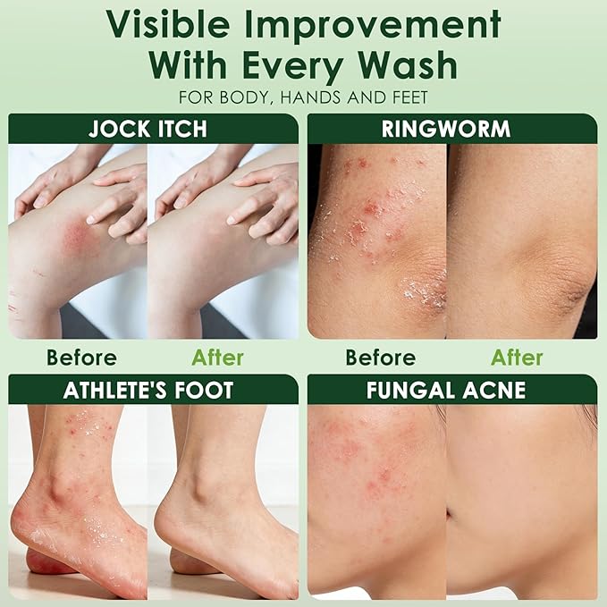 Antifungal Soap, Tea Tree Antifungal Soap Bar for Back Acne, Athlete's Foot, Tinea, Ringworm, Jock Itch, Face & Body Wash Soothing Care for Men And Women, Relief of Itchy
