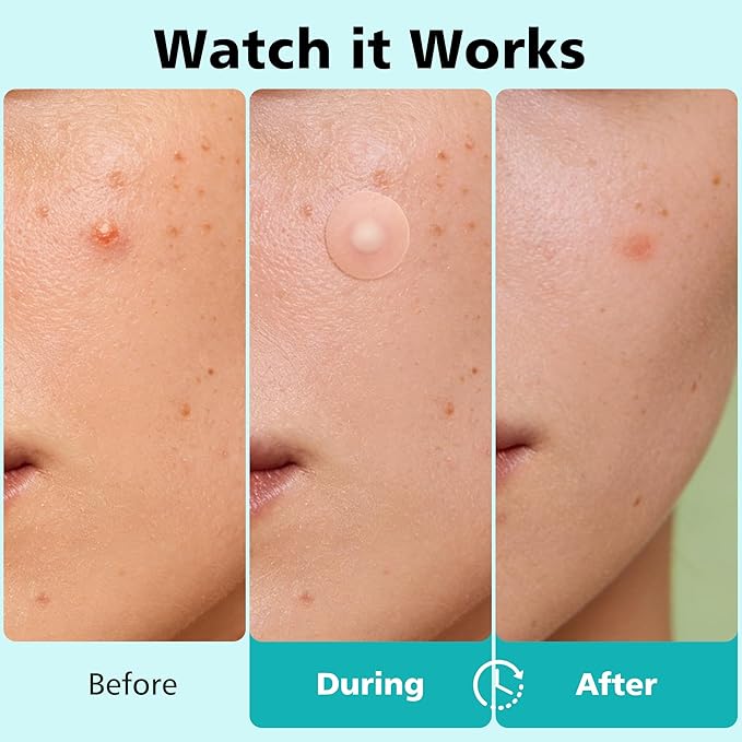 600 Counts Pimple Patches - Hydrocolloid Acne Patches for face, Pimple Stickers for Covering Zits and Blemishes, Gentle for All Skin Types(4 Size)