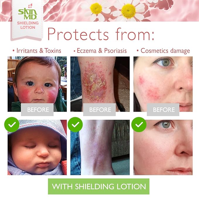 Skin MD Shielding Lotion - 4oz Hydrating Body Lotion for Sensitive Skin | Non-Greasy, Fast-Absorbing Moisturizer with Plant-Based Ingredients | Best Lotion for Dry Skin, Eczema & Psoriasis Relief